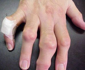 pirksti ar locītavu deformācijām izraisa sāpes