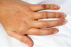sāpes deformētos pirkstos