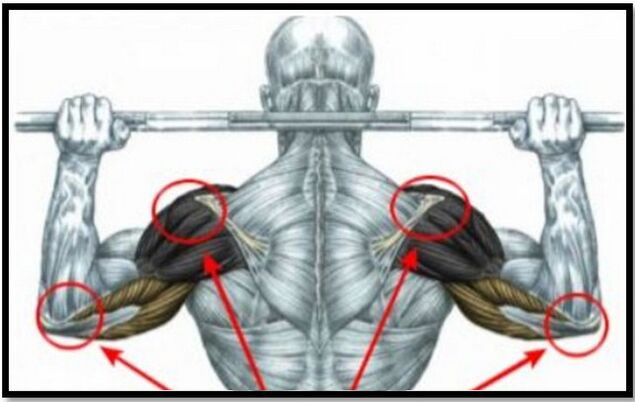 Slodze uz pleca un elkoņa muskuļiem ir viens no pleca locītavas artrozes cēloņiem