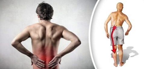 Sāpju sindroms ar jostas osteohondrozi izstaro kājas